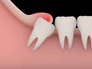 recover wisdom teeth surgery