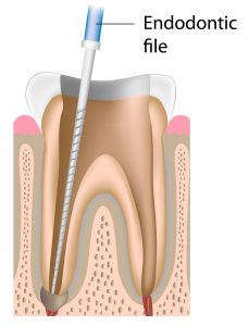 risk of broken files in root canal treatment