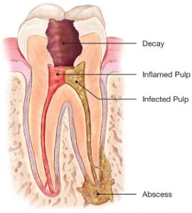 root canal treatment involve