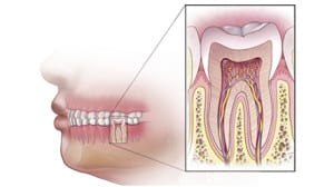 root canal treatment involve