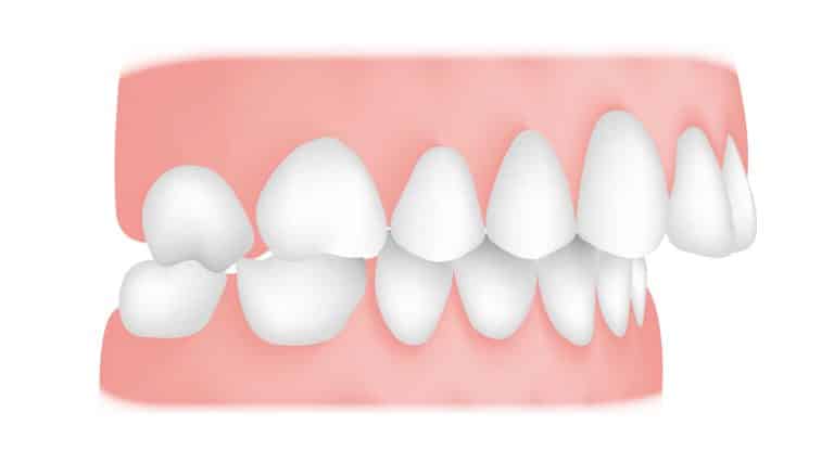 treatment of malocclusion