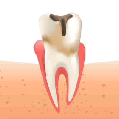 stages dental decay