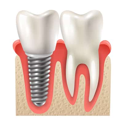 who should i see for dental and teeth implants