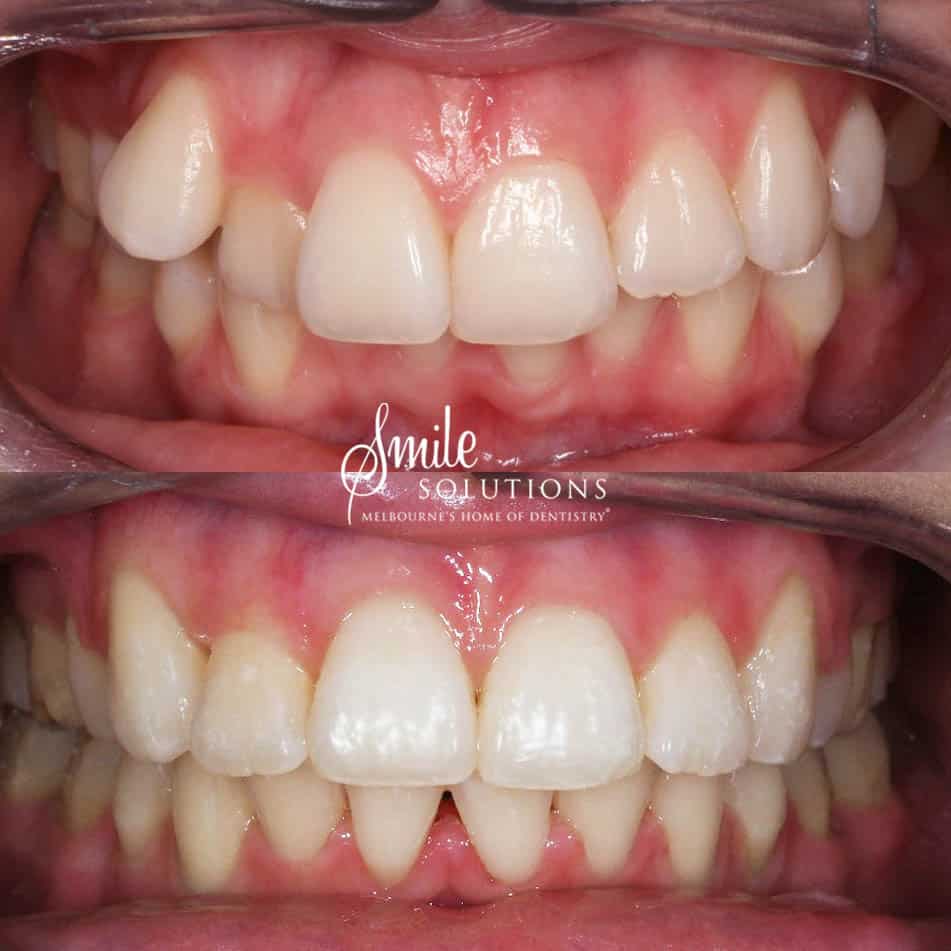 Braces Before and After 1