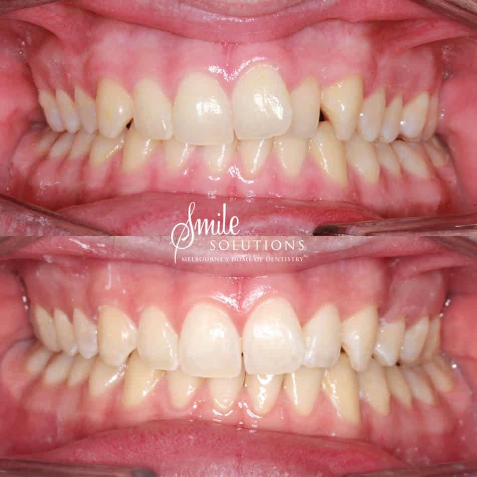 Invisalign Before and After 3