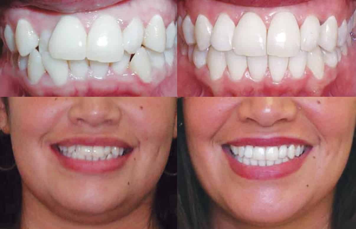 Invisalign Crossbite Before and After 1