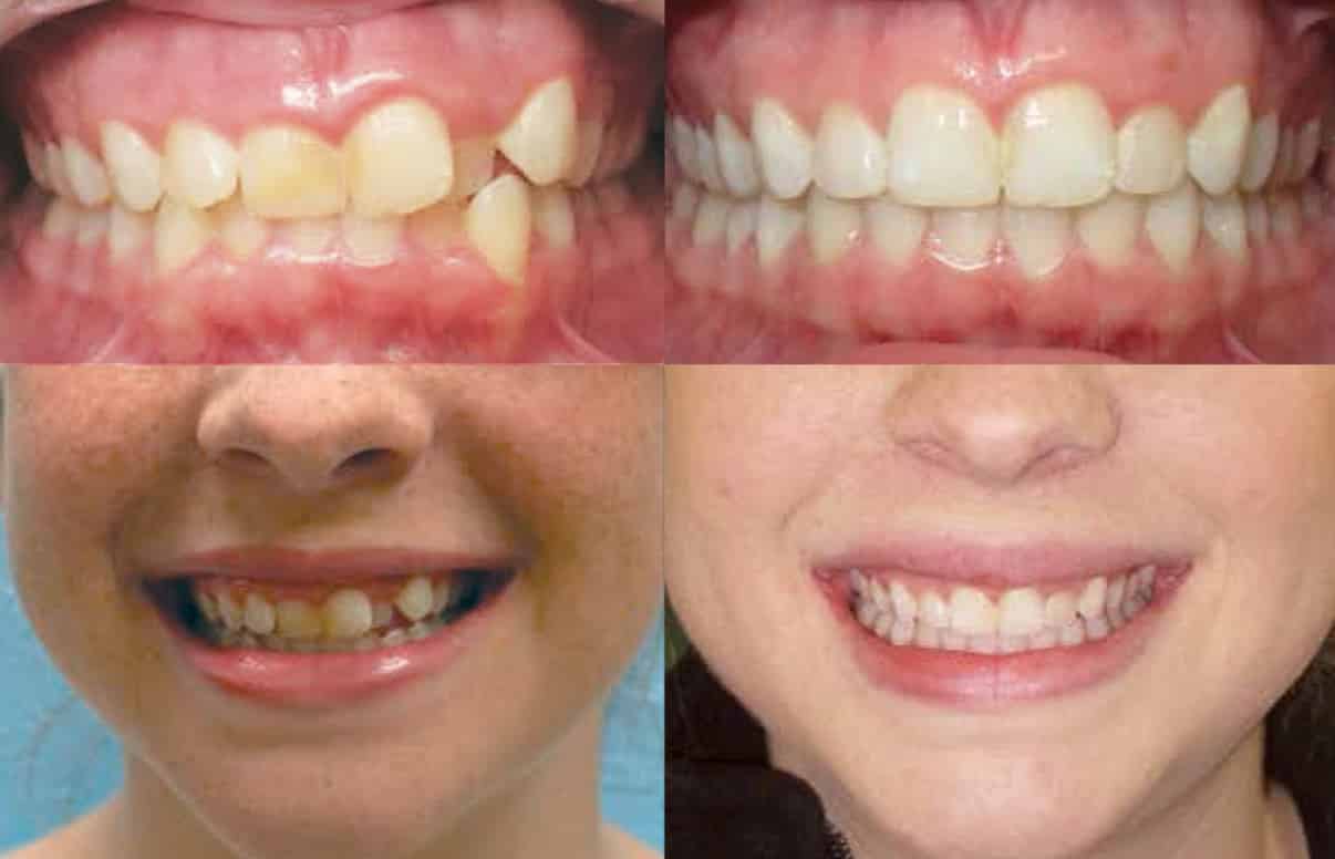 Invisalign Crossbite Before and After 2