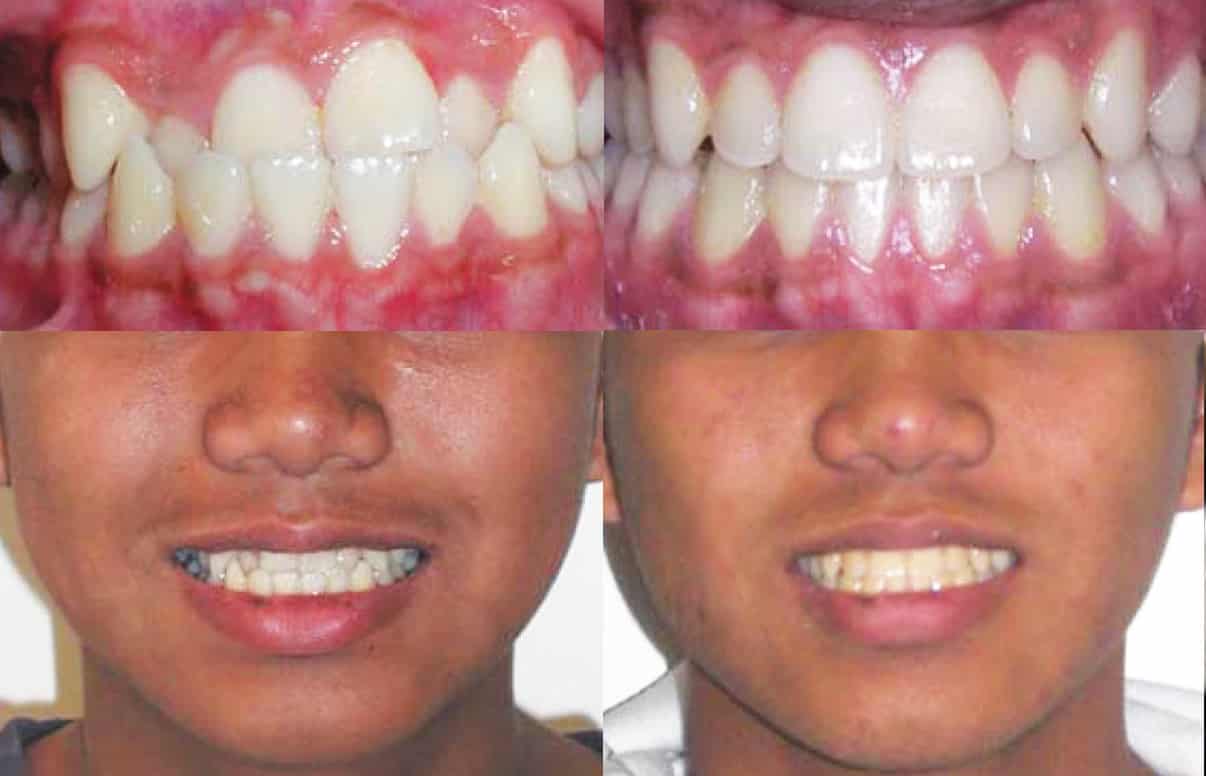 Invisalign Underbite Before and After 2
