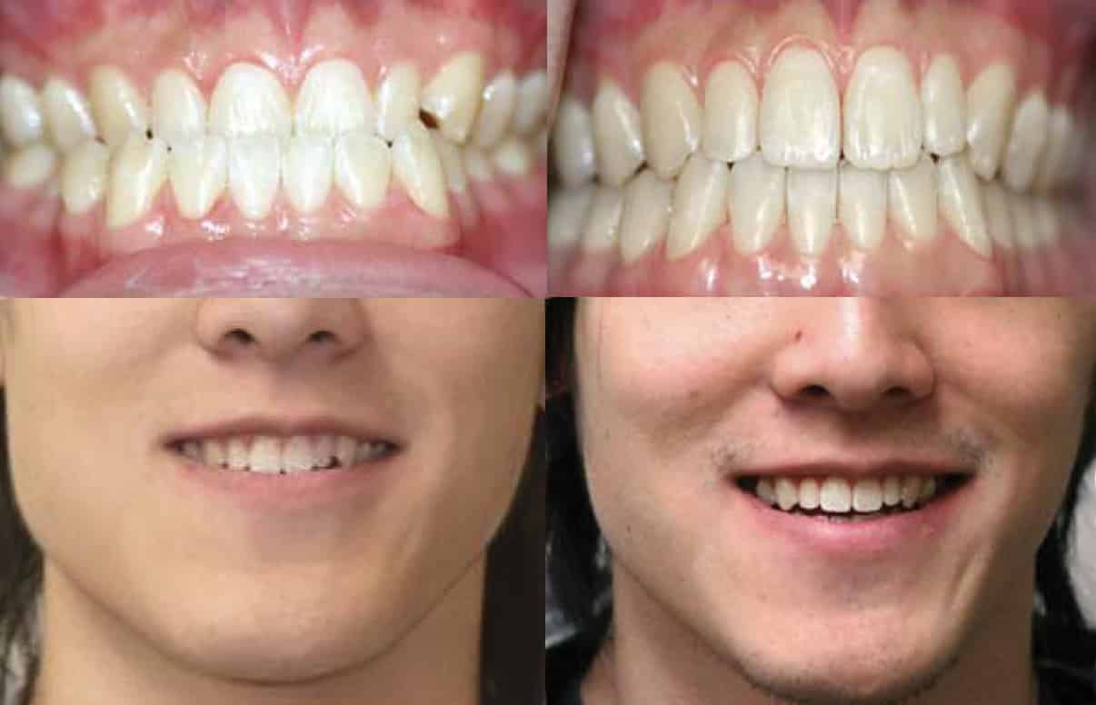 Invisalign Underbite Before and After