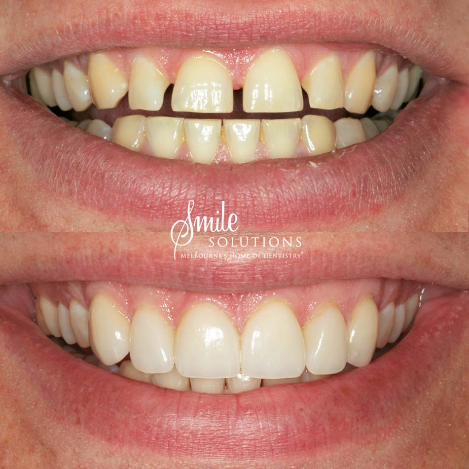 Porcelain Veneers Before and After 2