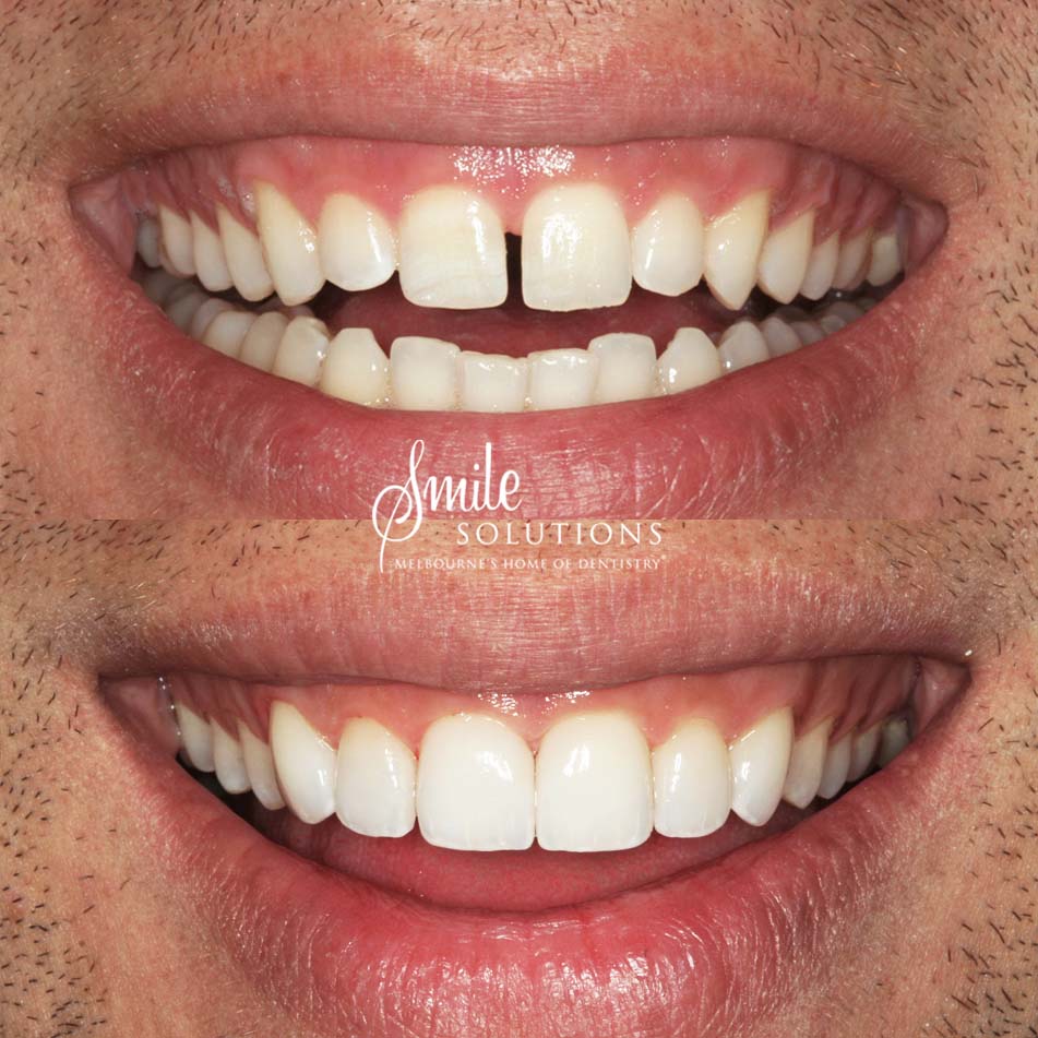 Porcelain Veneers Before and After 4