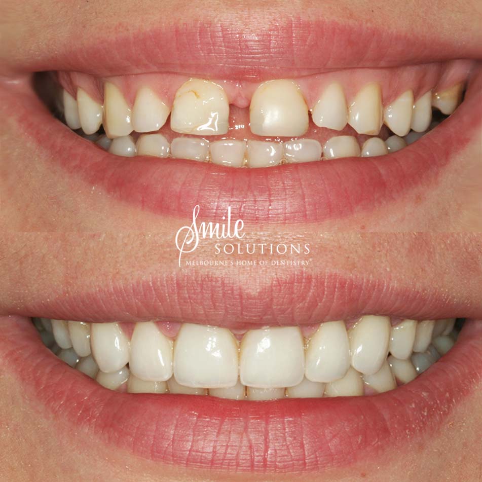 Porcelain Veneers Before and After 5