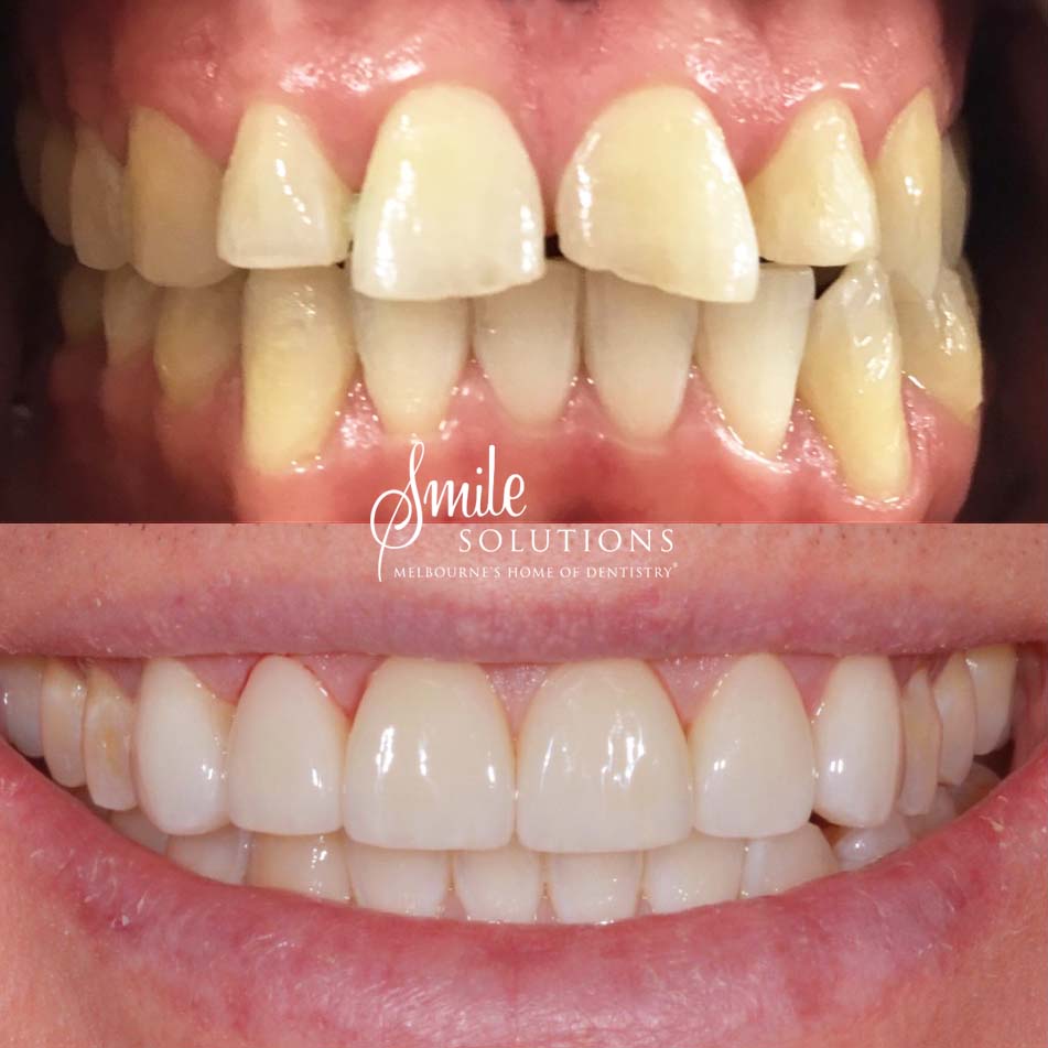 Porcelain Veneers Before and After 6