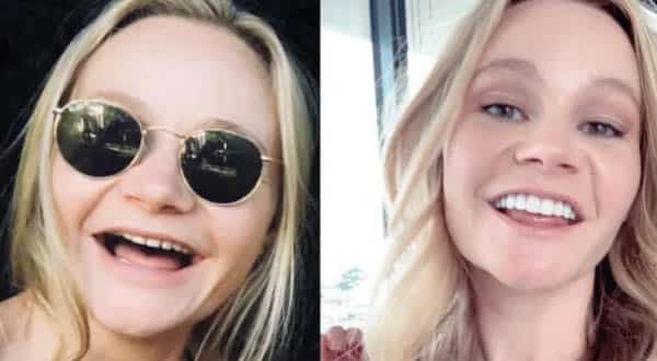 Rise in Veneers The Age