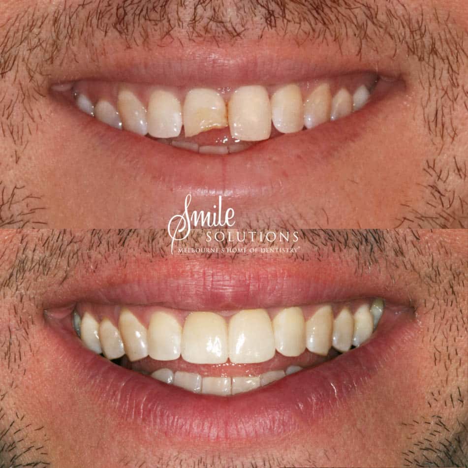 thumbnail image 2 of Dental Resin Composite Veneers For Front Teeth – Upper/Lower, Crowns Whitening Kit 2 of 3