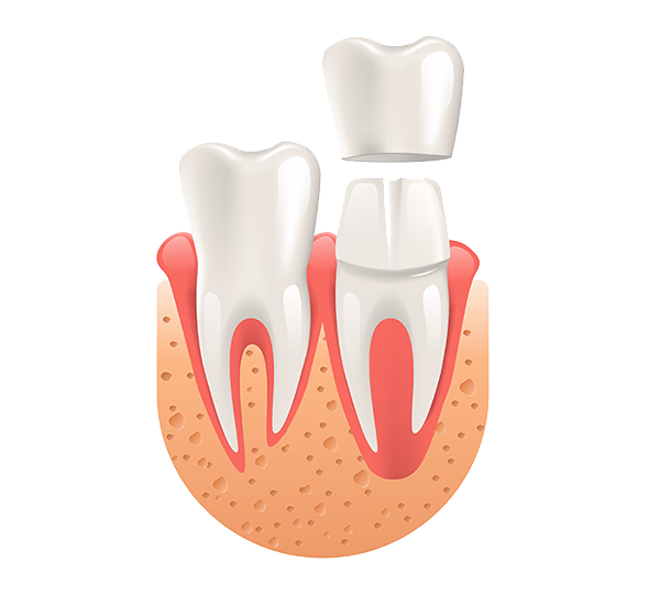 image porcelain crowns