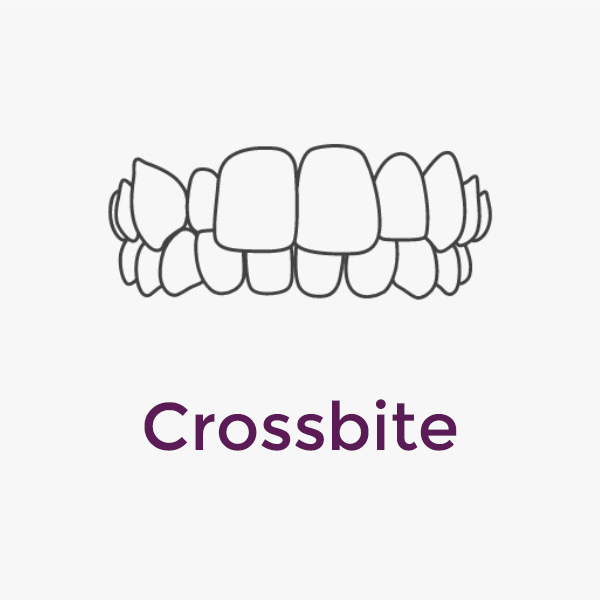 Invisalign Crossbite