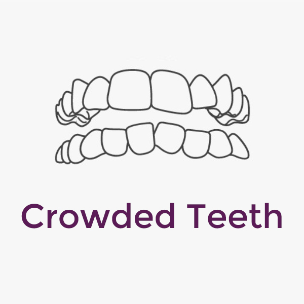Invisalign Crowded Teeth