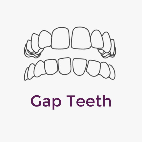 Invisalign Gap Teeth