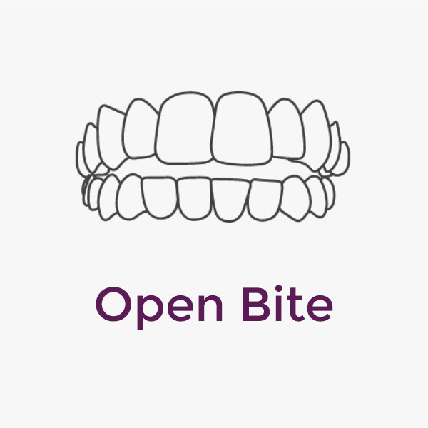 Invisalign Open Bite