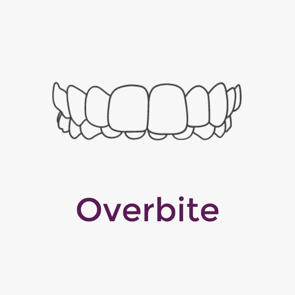 Invisalign Overbite