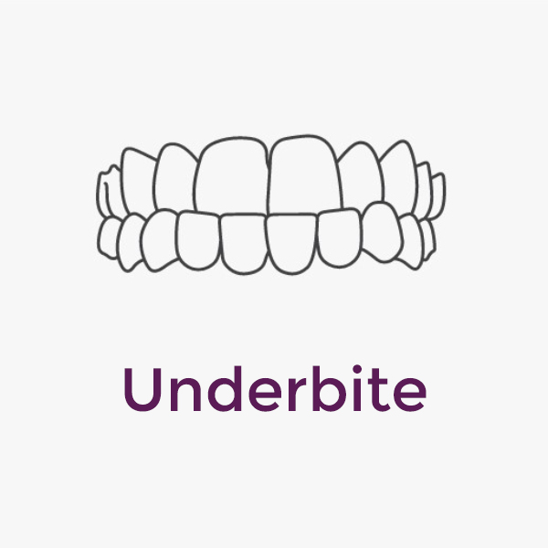 Invisalign Underbite