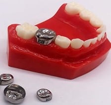 Dental Crowns for Children – Silver or White? 1 Picture3