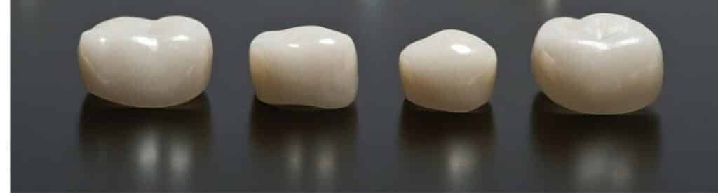 Dental Crowns for Children – Silver or White? 2 Picture4