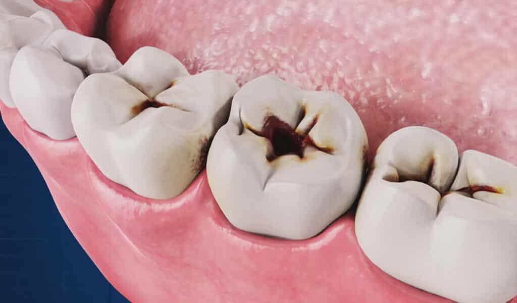 dental decay