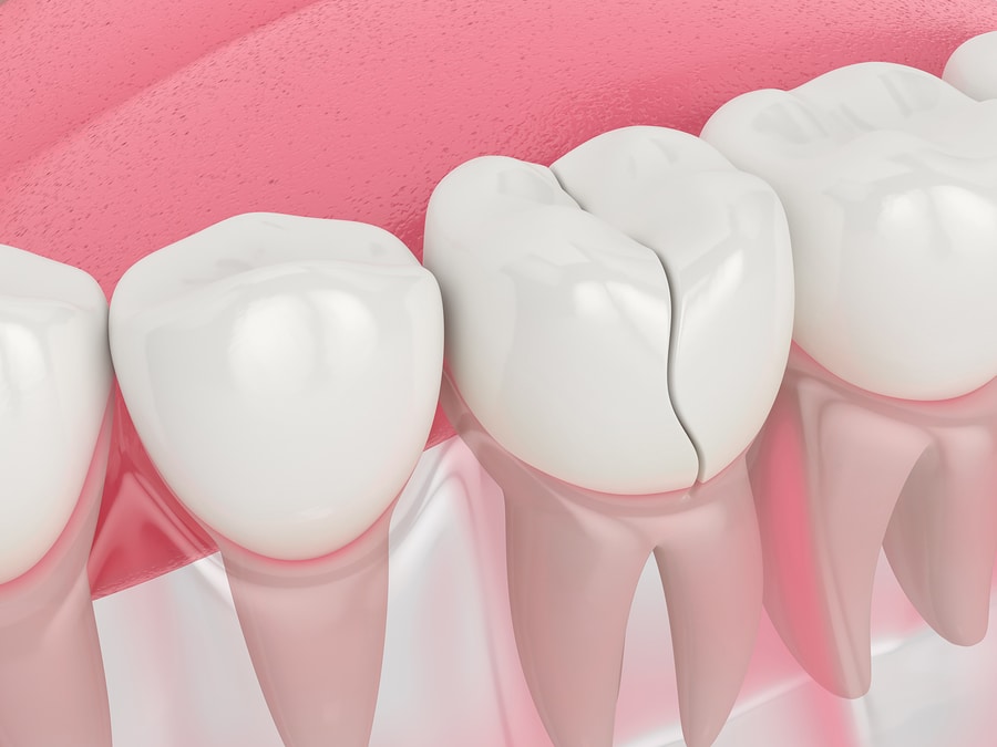 bigstock d Render Of Jaw With Treatabl 350252323