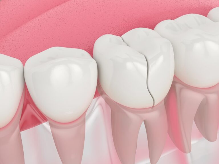 crcaked tooth