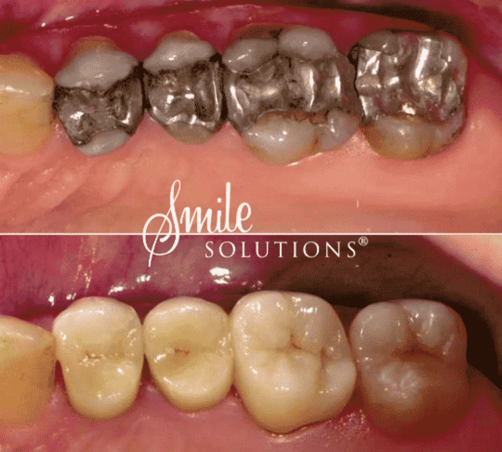 CEREC restoration