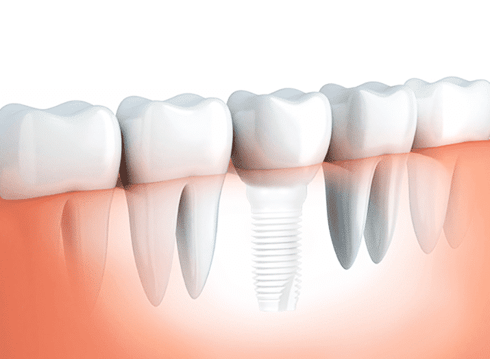 Conventional Dental Implants