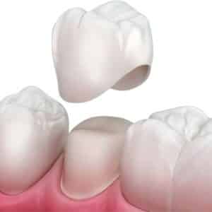 Dental Crown at Smile Solutions