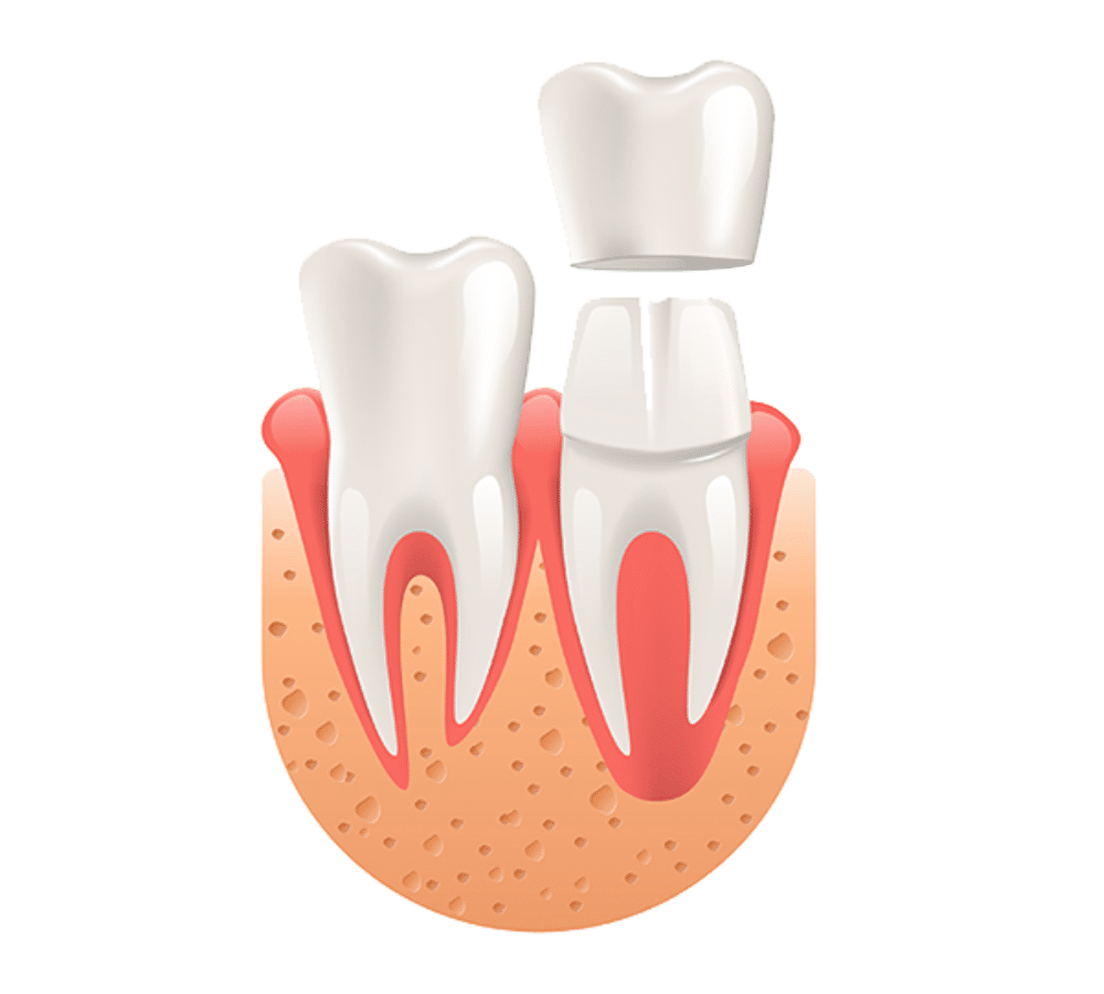 Porcelain Crowns at Smile Solutions