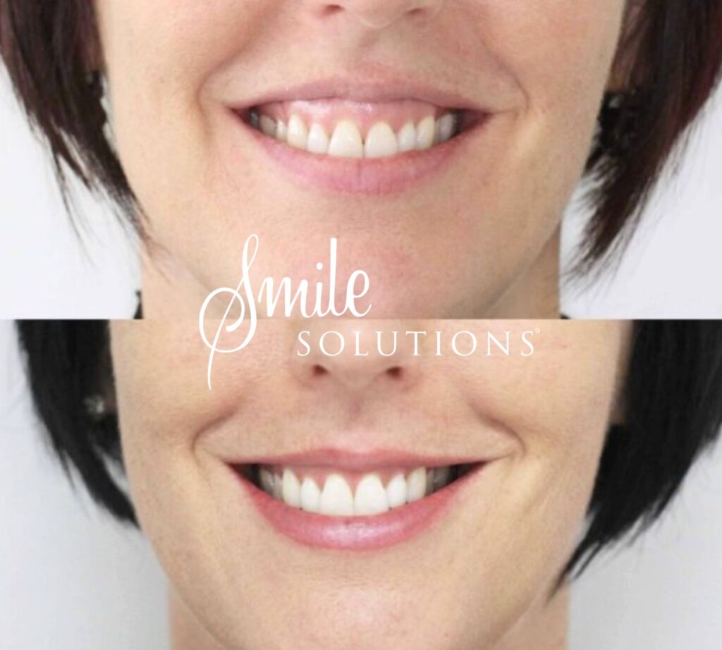 Cosmetic Dentistry 8 Gummy Smile