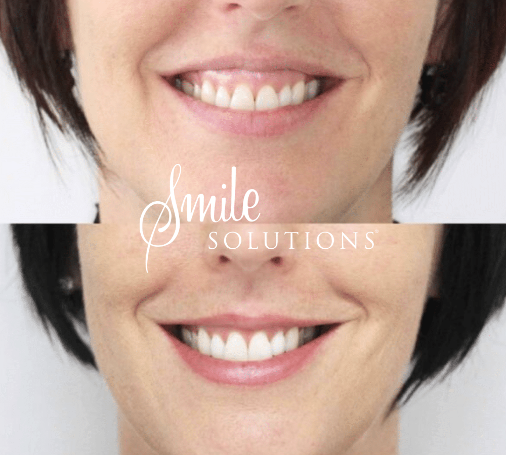Gummy Smile Smile Solutions