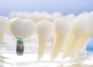 Immediate Dental Implants 2 1