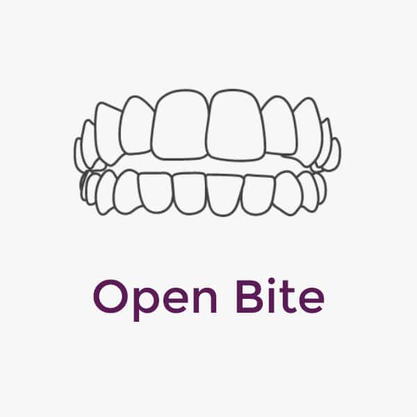 Invisalign Open Bite