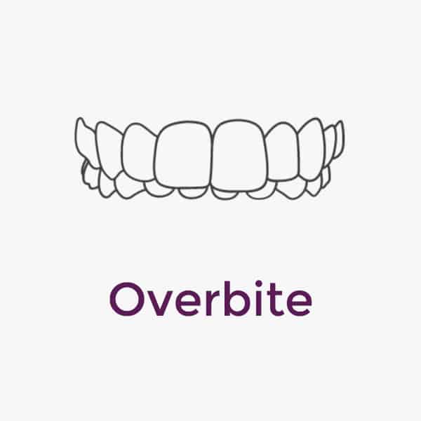 Invisalign Overbite