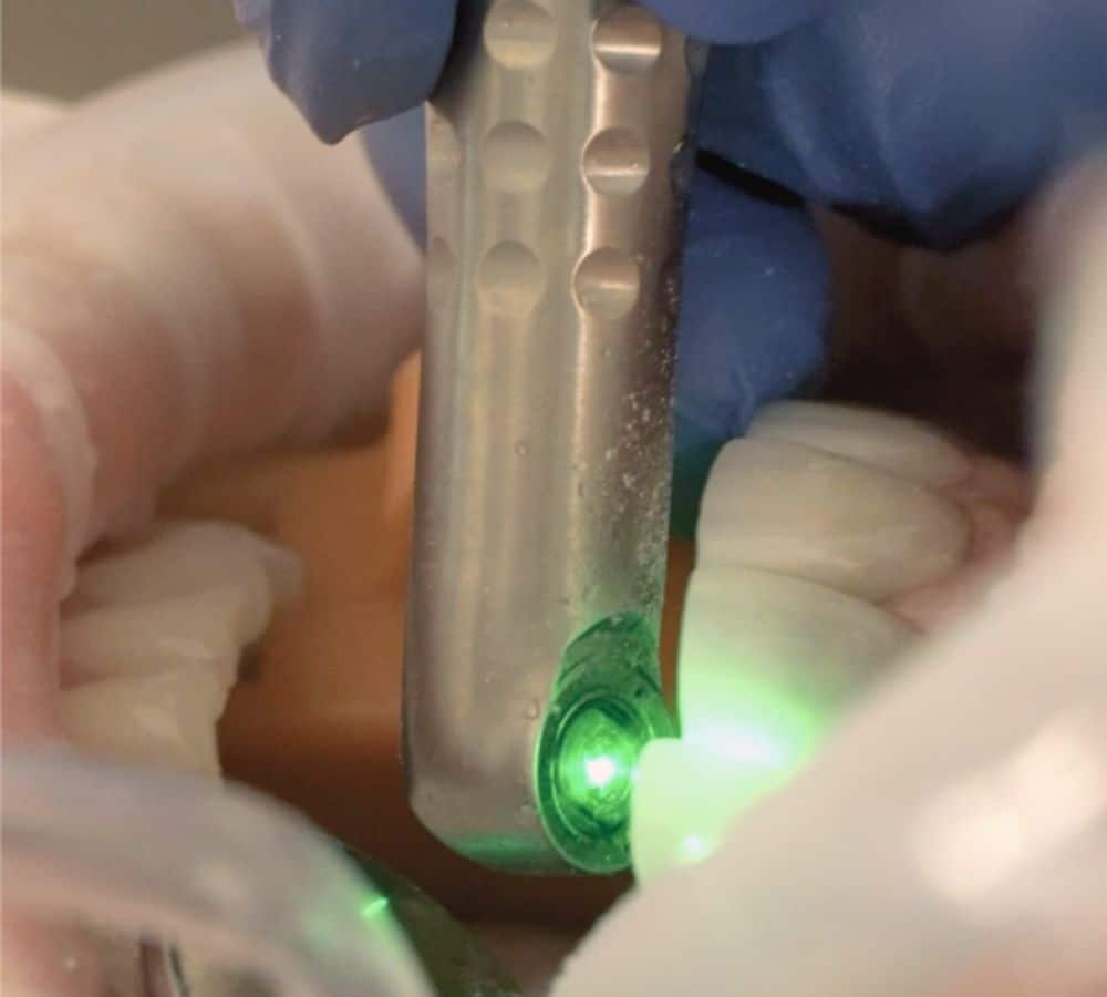 Laser Dentistry for Obstructive Sleep Apnoea