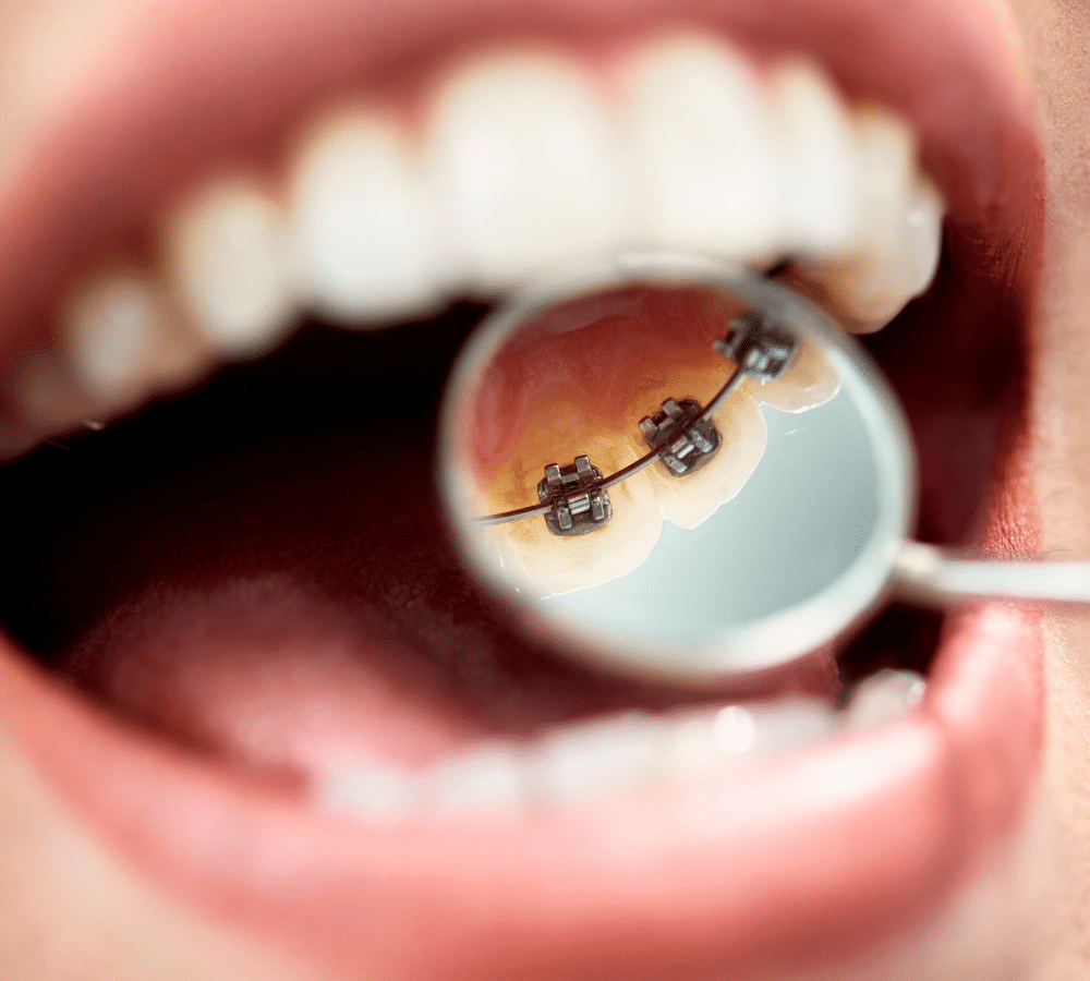 Internal Lingual Braces