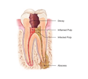 Tooth anatomy with decay and infection