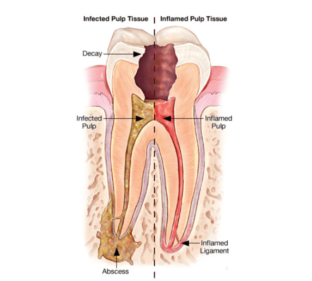 Root Canal 2 Root Canal