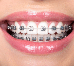 Traditional braces Smile Solutions Specialist Orthodontist