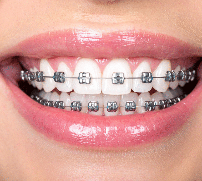 Traditional braces Smile Solutions Specialist Orthodontist