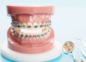 Traditional and Clear Braces 1