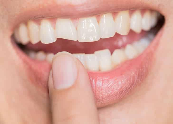 What should I do if I have a chipped tooth?