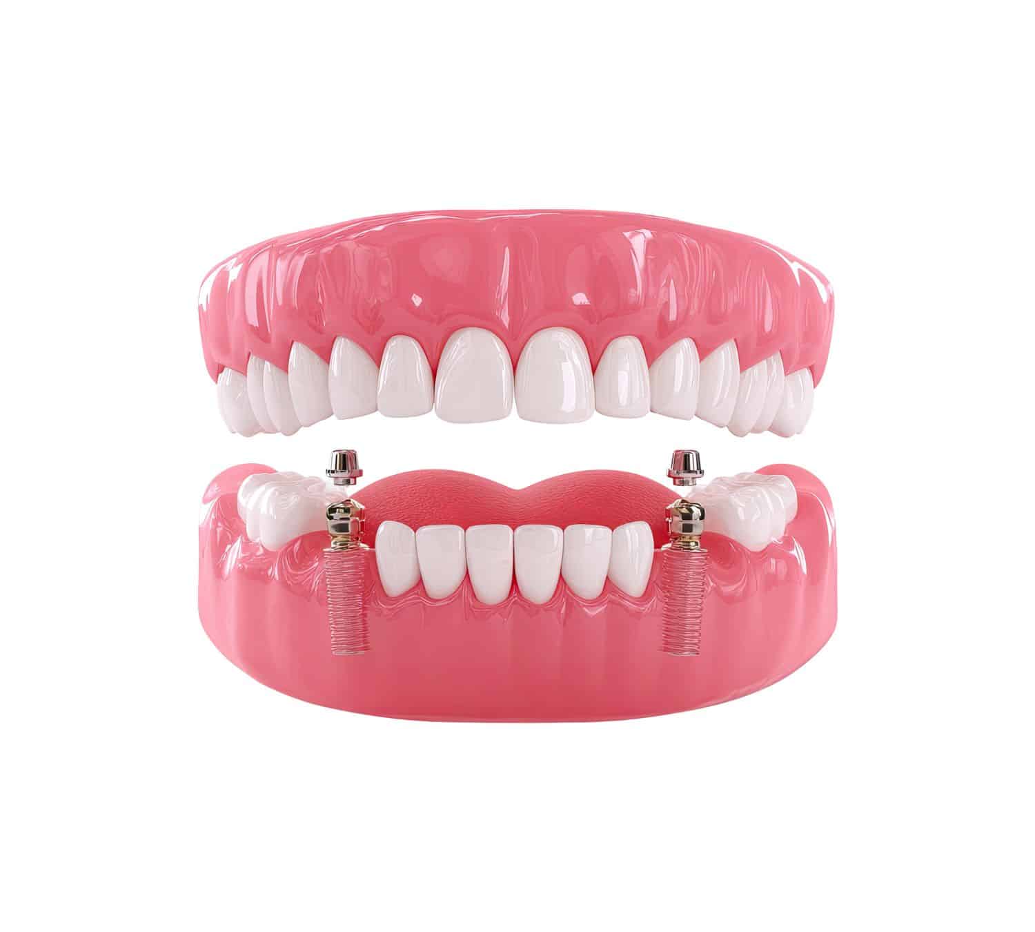 Dentures 5 Over-Denture