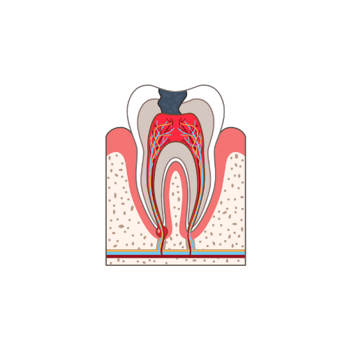 Root Canal 4 Step 1: Examination and anesthesia
